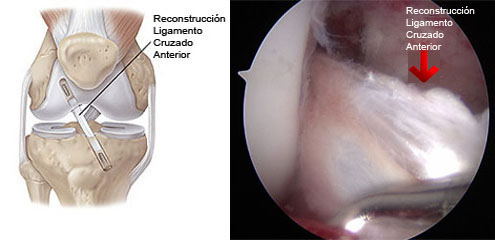 Reconstrucción del Ligamento Cruzado Anterior por el Dr. Aldo Bauza en CDMX